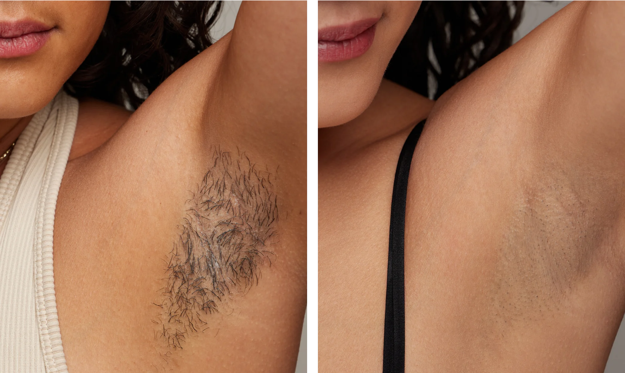 Before and after underarm hair removal comparison on a woman, showing a significant reduction in hair for smoother skin.