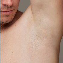 Before and after underarm hair removal comparison on a man, showing a significant reduction in hair for smoother skin.