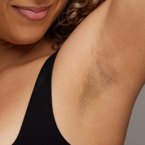 Before and after underarm hair removal comparison on a woman, showing a significant reduction in hair for smoother skin.