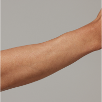 Before and after arm hair removal comparison on a person, showing smoother skin with reduced hair.