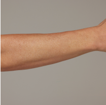 Before and after arm hair removal comparison on a person, showing smoother skin with reduced hair.