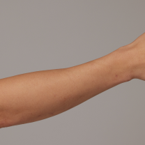 Before and after arm hair removal comparison on a person, showing smoother skin with reduced hair.