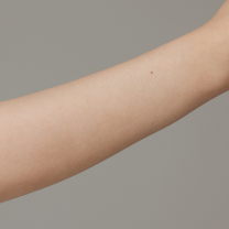 Before and after arm hair removal comparison on a person, showing smoother skin with reduced hair.