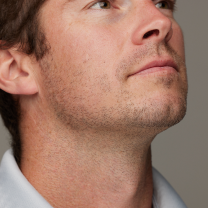 Before and after facial hair removal comparison on a man, showing reduced beard growth and smoother skin.