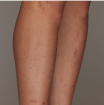 Before and after leg hair removal comparison on a person, showing smoother skin and reduced hair.