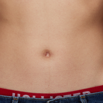 Before and after stomach hair removal comparison on a man, showing reduced body hair and smoother skin.