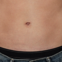 Before and after stomach hair removal comparison on a man, showing reduced body hair and smoother skin.