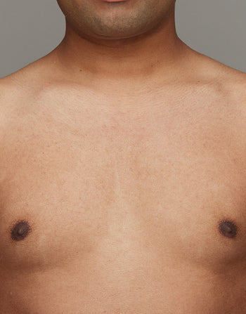 After effective IPL Hair Removal for Chest area with Ulike Air