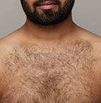 The effect of using ulike air 10 before chest hair removal