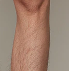 The effect of using ulike air 10 before leg hair removal