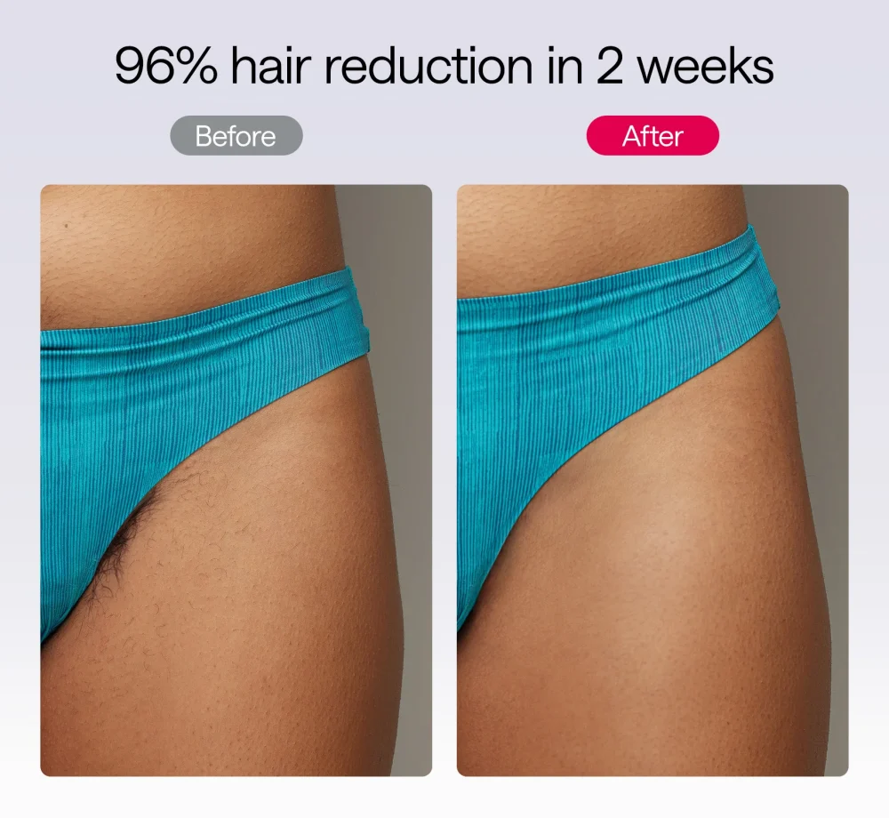 ULIKE Air 10 IPL Hair Removal Device - Image 7